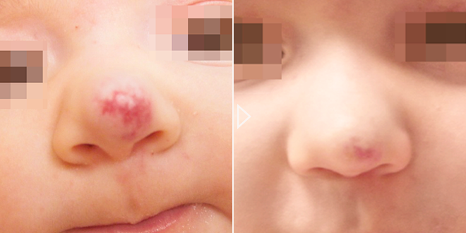 Traitement des lésions vasculaires pédiatriques