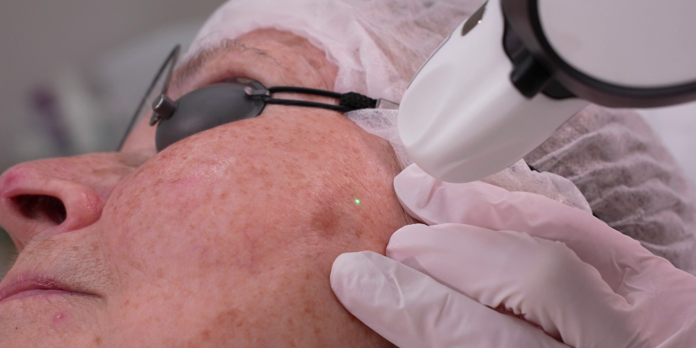 Traitement des lésions pigmentaires (Pinpoint Coagulation™)