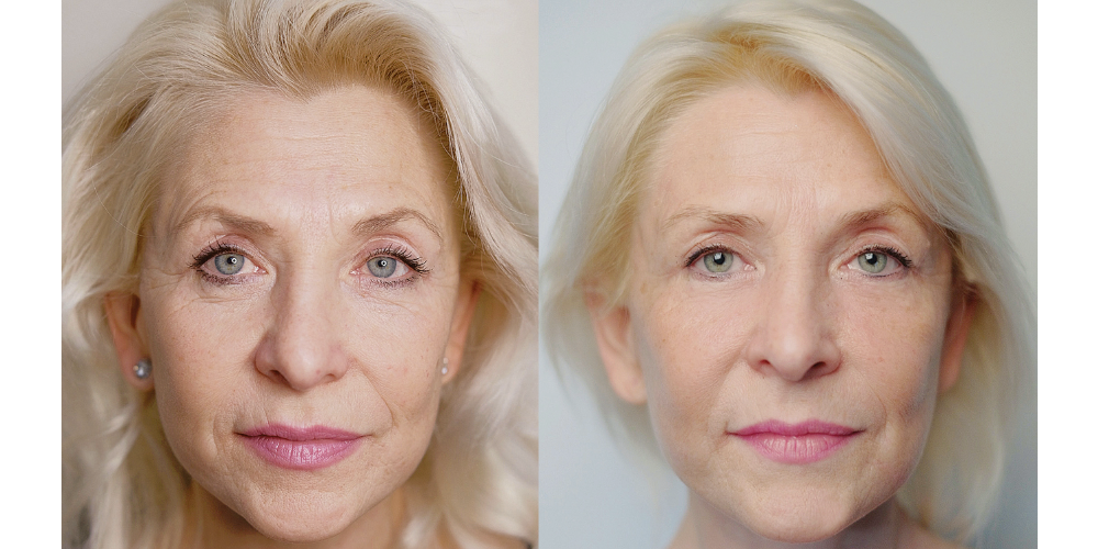 Er:YAG 2940 nm + Module SMA (RecoSMA®) - Ablation et émetteur régénératif