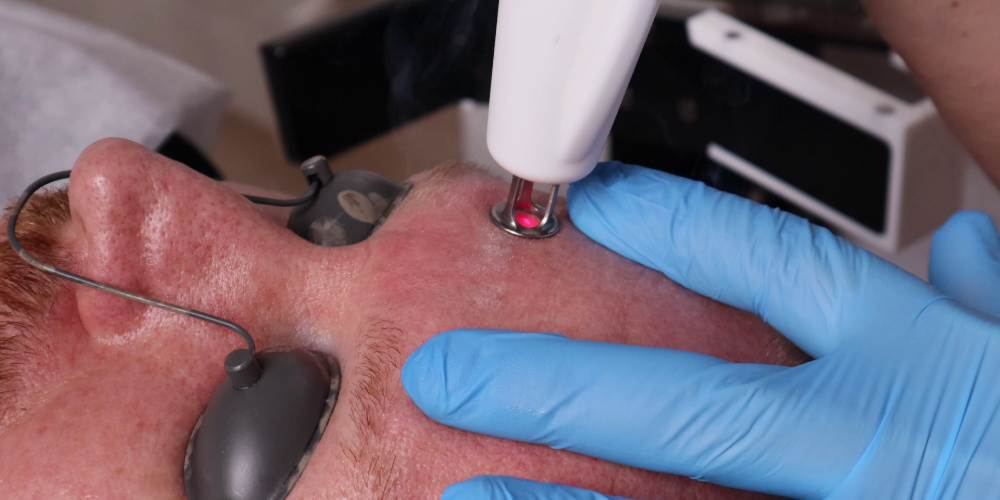 RecoSMA® – Une avancée dans la technologie de régénération laser