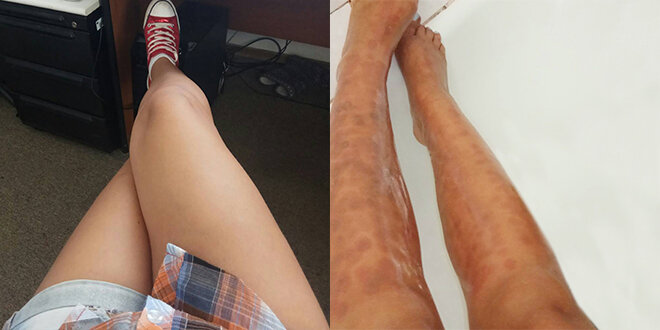 Эпилировать или просто сжечь ?